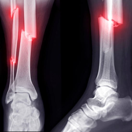 Fracture Treatment
